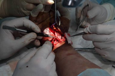 Bileği dikmek için ameliyat. Beyin cerrahları ve travmatologlardan oluşan ekip eli onarıyor. Bilekte sinir ve tendon dikmek için ameliyat.