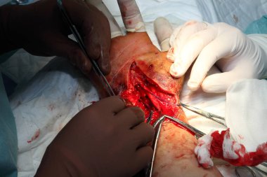 Bileği dikmek için ameliyat. Beyin cerrahları ve travmatologlardan oluşan ekip eli onarıyor. Bilekte sinir ve tendon dikmek için ameliyat.