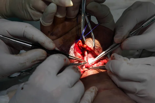 Cirugía Para Coser Muñeca Equipo Neurocirujanos Traumatólogos Restaura Mano Cirugía —  Fotos de Stock