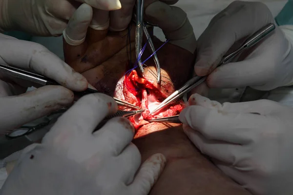 Chirurgický Zákrok Zápěstí Tým Neurochirurgů Traumatologa Obnoví Ruku Chirurgický Zákrok — Stock fotografie