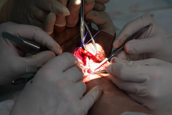 Cirurgia Para Coser Pulso Equipe Neurocirurgiões Traumatologistas Restaura Mão Cirurgia — Fotografia de Stock