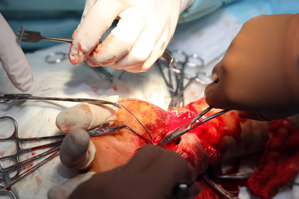 手首を縫う手術神経外科医と外傷学者のチームは手を復元します 手首の神経と腱を縫う手術 — ストック写真