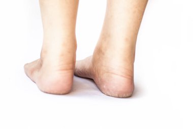 Kış sezonunda çatlak topuklu beyaz kavramı izole kurutulmuş deri ile kurutulmuş çatlak topuk gösteren kadın bacak veya topuk yakın.