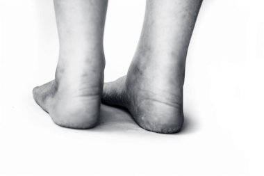 Kış sezonunda çatlak topuklu beyaz kavramı izole kurutulmuş deri ile kurutulmuş çatlak topuk gösteren kadın bacak veya topuk yakın.