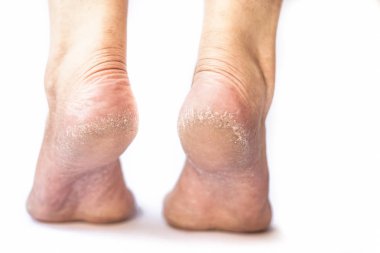 Beyaz arka planda iki kuru ayak, yakın plan.  