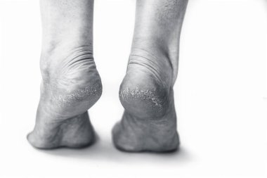 Kış sezonunda çatlak topuklu beyaz kavramı izole kurutulmuş deri ile kurutulmuş çatlak topuk gösteren kadın bacak veya topuk yakın.