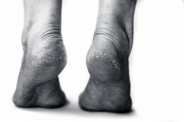 Beyaz arka planda iki kuru ayak, yakın plan.  