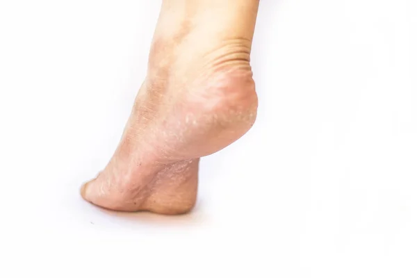 Zbliżenie Pojedynczej Kobiecej Nogi Lub Pięty Pokazując Wysuszony Popękane Pięty — Zdjęcie stockowe
