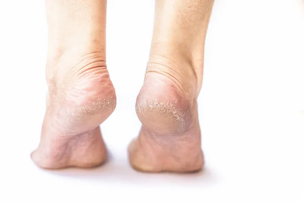 Kış sezonunda çatlak topuklu beyaz kavramı izole kurutulmuş deri ile kurutulmuş çatlak topuk gösteren kadın bacak veya topuk yakın.