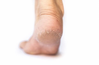 Kış sezonunda beyaz çatlak topuklu ayakkabı konsepti nde izole edilmiş kurutulmuş deriile kurutulmuş çatlak topuk gösteren tek bir dişi bacak veya topuk yakın.;