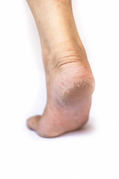 Close Single Female Leg Heel Showing Dried Cracked Heel Dried — Stock Photo, Image