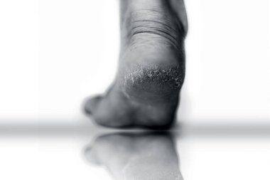 Tek kadın bacak veya topuk kurutulmuş çatlak hee gösteren yakın