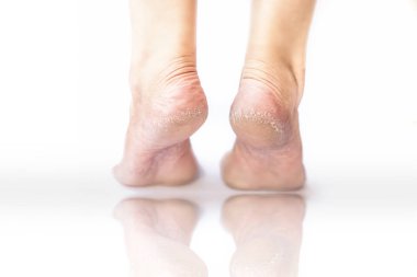 Yakın kadın bacak veya topuk ile kurutulmuş çatlak topuk gösteren