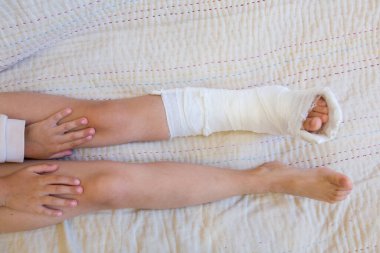 Kırık bacak. Ayağındaki alçıya yakın çekim. Kas onarma ve güçlendirme egzersizleri. Kemiklerde hasar var. Acil servisteki bir cerrahın tıbbi bakımı.