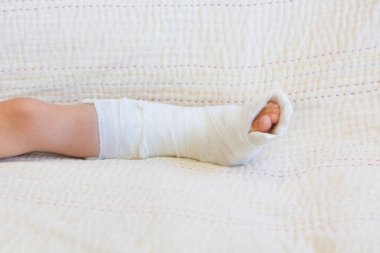 Kırık bacak. Ayağındaki alçıya yakın çekim. Kas onarma ve güçlendirme egzersizleri. Kemiklerde hasar var. Acil servisteki bir cerrahın tıbbi bakımı.