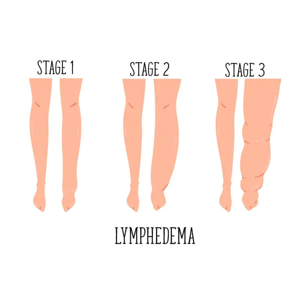 Stadi Linfedema Disfunzione Del Sistema Linfatico Elefantiasi Gonfiore Alle Gambe — Vettoriale Stock