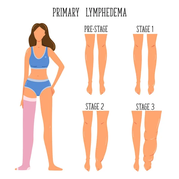 Primaire Lymfoedeem Stadia Lymfatisch Systeem Disfunctie Olifanten Benen Zwelling Ziekte — Stockvector