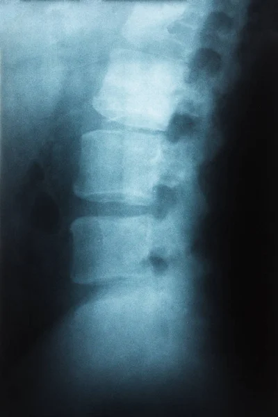 Radiografía Película Columna Lumbar Columna Vista Lateral Espondilolitesis Grado Altura — Foto de Stock