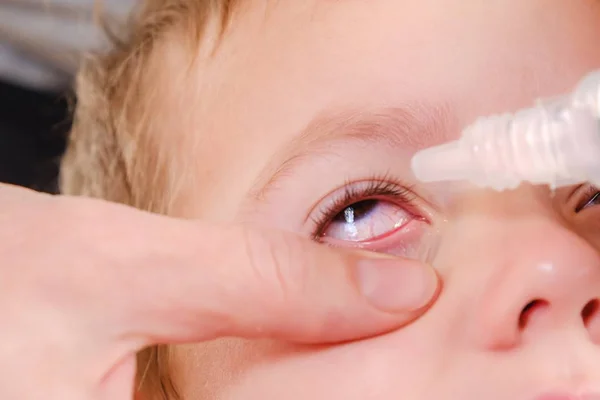 Alergia Ocular Infantil Conjuntivitis Infección Roja Alérgica Infancia — Foto de Stock