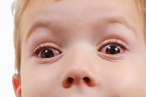 Kind Bindehautentzündung rotes Auge mit Infektion, Virus. — Stockfoto