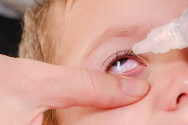 Alergia ocular infantil y conjuntivitis roja alérgica, polen . — Foto de Stock