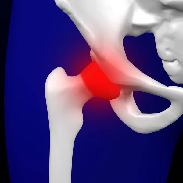 Disease of the joints. 3D rendering. — Stock Photo, Image