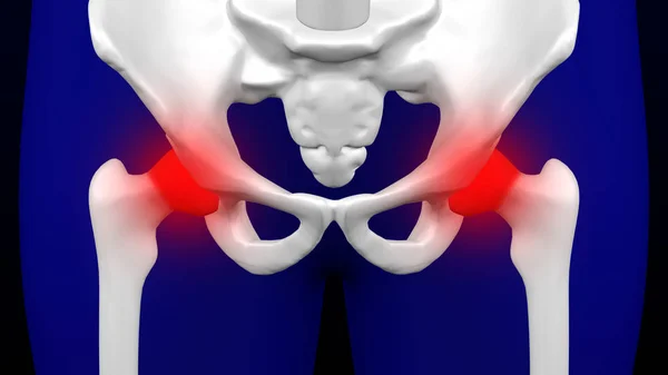 Disease of the joints. 3D rendering.