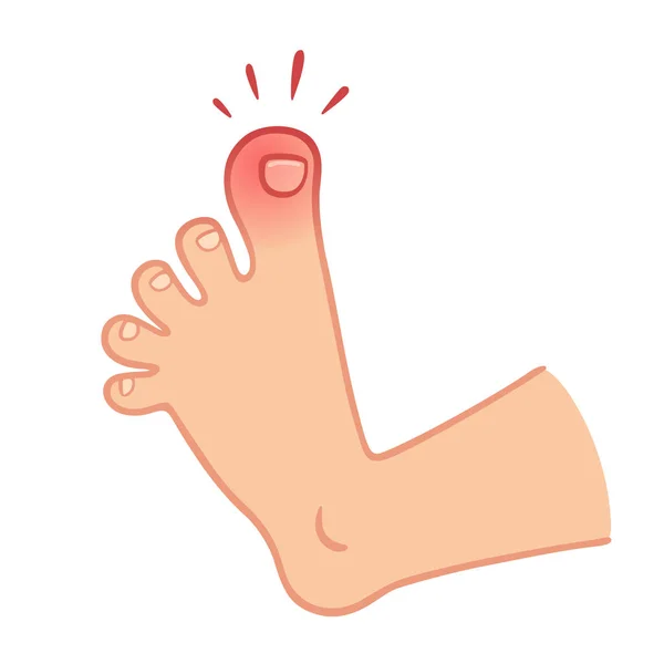 Cartoon Foot Swollen Stubbed Toe Pain Trauma Vector Illustration — Stock Vector