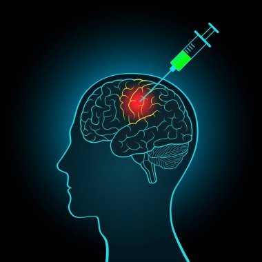 The injection syringe to the brain, the concept of direct treatment of brain tumors and other diseases clipart