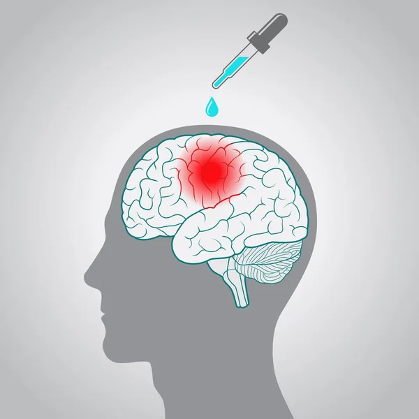 Gotas desde el gotero hasta el cerebro, el concepto de un tratamiento directo de tumores y otras enfermedades del cerebro — Archivo Imágenes Vectoriales