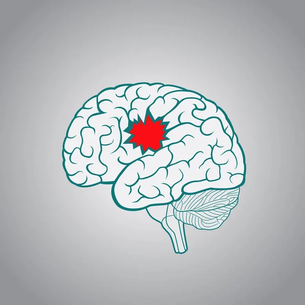 Ein Gehirn mit einem Loch, das Konzept der Zerstörung des Gehirns, Gedächtnisses, Schlaganfall, Krankheit — Stockvektor