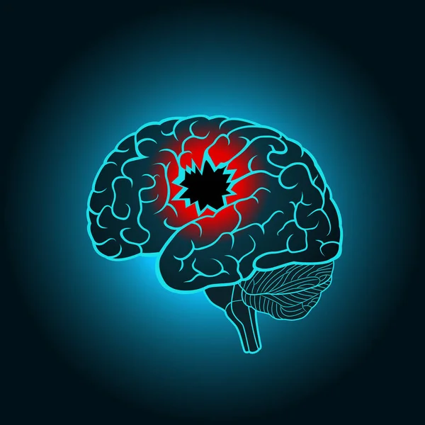 Um cérebro com um buraco, o conceito de destruição do cérebro, memória, acidente vascular cerebral, doença —  Vetores de Stock