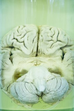 İnsan beyninin formalin çözüm closeup, tıbbi araştırma