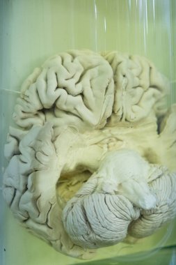 İnsan beyninin formalin çözüm closeup, tıbbi araştırma