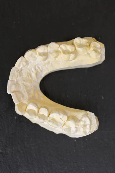 Gipsabguss Von Zähnen Kiefer Einer Person Gipsabguss Der Zähne Zukünftiger — Stockfoto