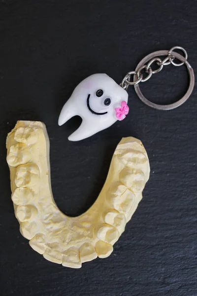 Plaster cast of teeth in the jaw of a person. A plaster cast of the teeth of future implants.