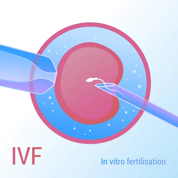 FIV. Inseminação artificial. Design vetorial realista 3d —  Vetores de Stock