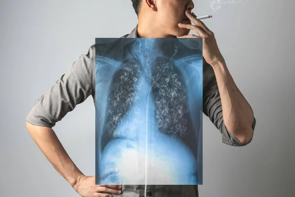 Man Smoking Dangerous Cigarette Ray Lung — Stock Photo, Image