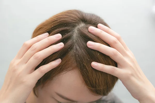 Lupy Mastné Vlasy Hlavě Mladé Ženy Nezdravá Kůže Hlavy — Stock fotografie