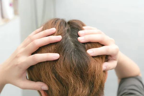Lupy Mastné Vlasy Hlavě Mladé Ženy Nezdravá Kůže Hlavy — Stock fotografie