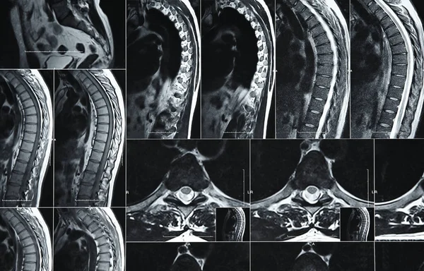 Imágenes Resonancia Magnética Tomografía Computarizada Columna Lumbar Humana — Foto de Stock