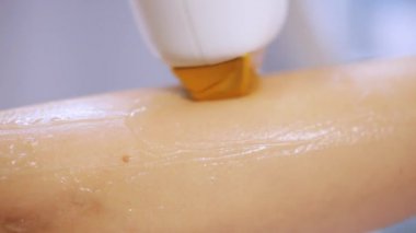 Lazer epilasyon diode lazer üzerinde makro yakın çekim prosedürü