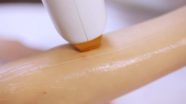 Procedimiento de primer plano de eliminación de pelos en la mano. depilación láser en un láser de diodo — Vídeo de stock