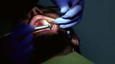 Diş hekimi diş doldurmak için hasta diş sondaj