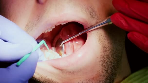 Primer plano del paciente en la clínica dental. Dentista está perforando diente de hombre para llenar un diente — Vídeos de Stock