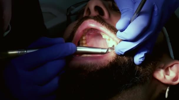 Dentista está perforando diente de hombre para llenar un diente — Vídeo de stock