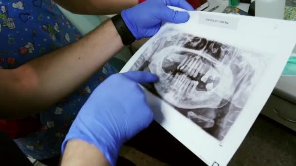 Close-up dari dua cetakan gigi, rekan-rekan mendiskusikan pengobatan . — Stok Video