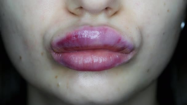 Macro close-up of swollen lips after injections of hyaluron, lip augmentation — Stock Video
