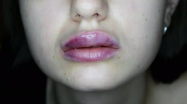 Hyaluron enjekte edildikten sonra şişmiş dudakların yakın çekimi, dudak büyütme.