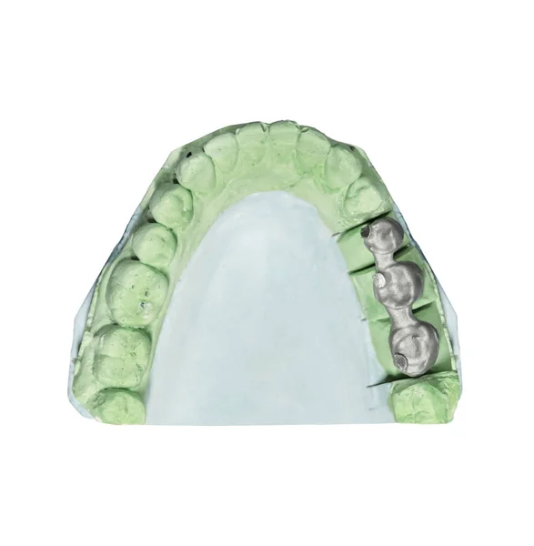 Dental tooth implant plaster pattern with metal bridge isolated on white